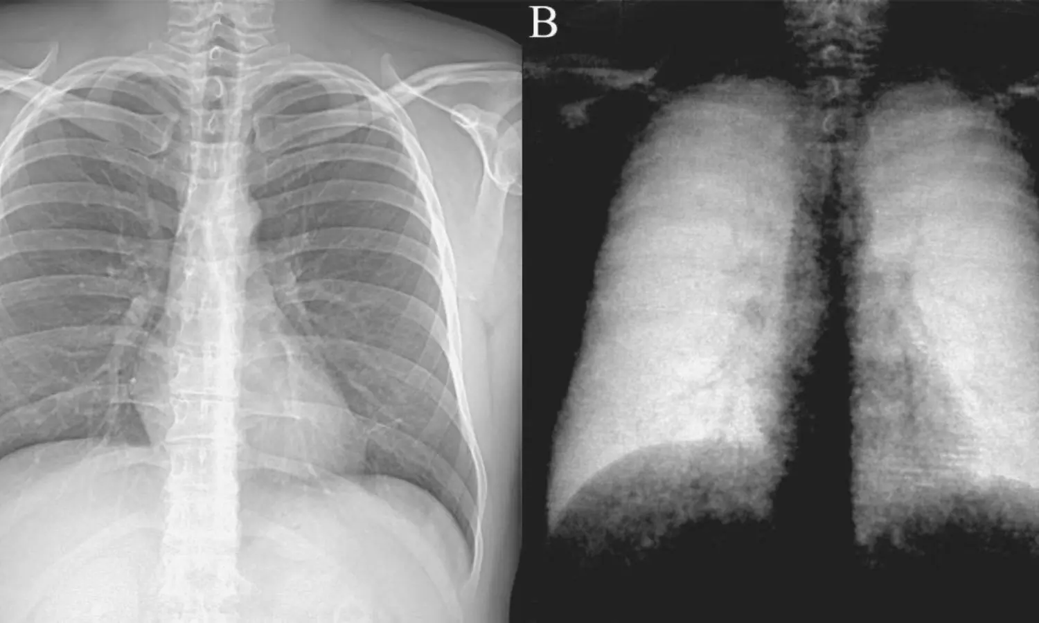 Dark-field chest X-ray helpful for differentiating emphysema from fibrosis: Study