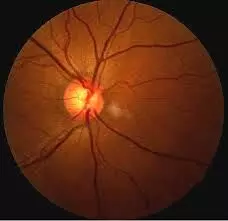 OCT angiography can detect microvascular changes predictive of normal-tension glaucoma