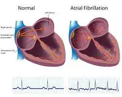 DR-FLASH score useful tool to predict ideal ablation strategy for patients with AF: study