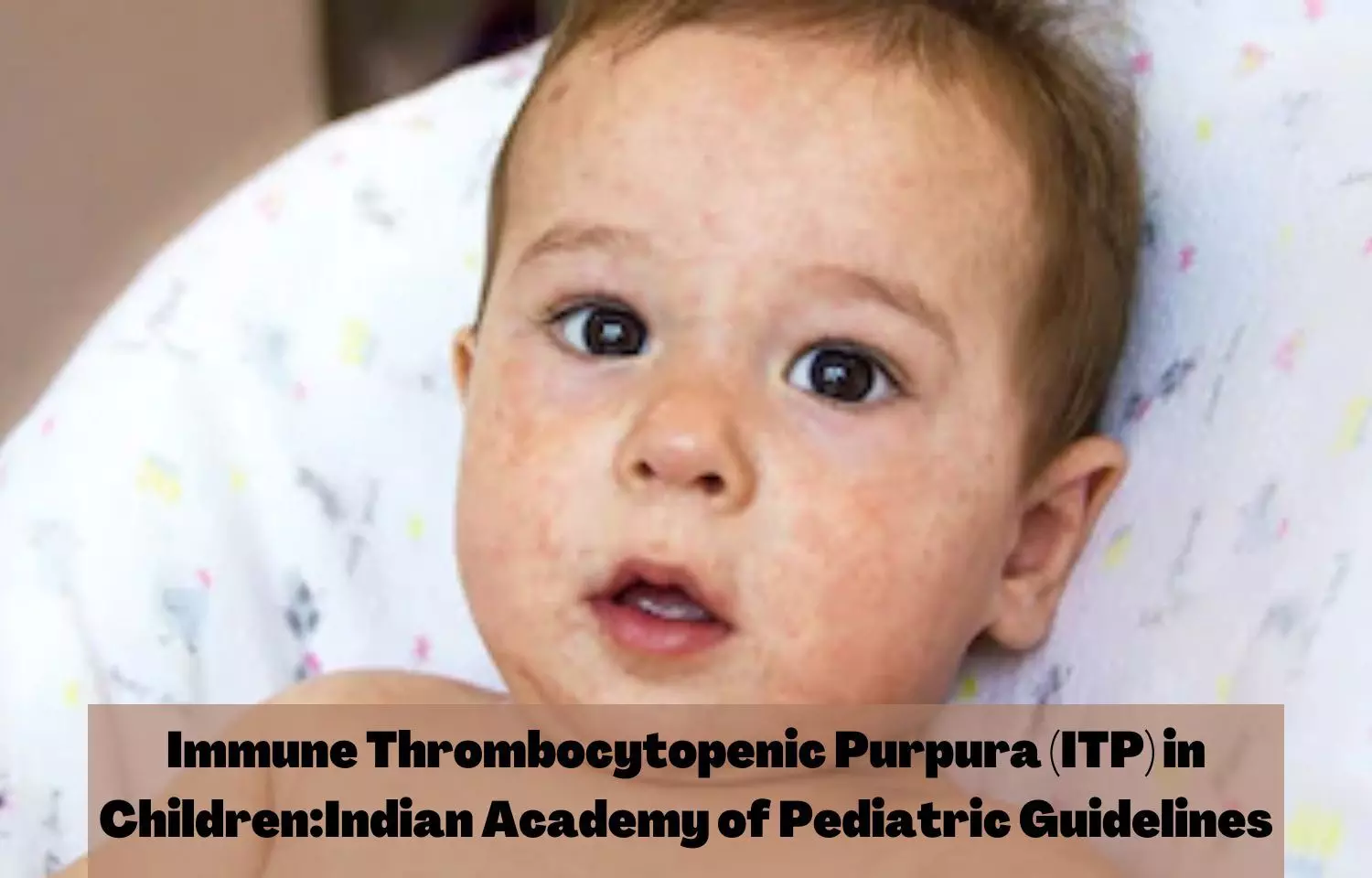 Immune Thrombocytopenic Purpura (ITP) in Children:  IAP Guidelines