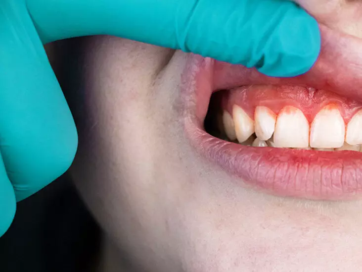 Improvement of oral health and hygiene may help mitigate inflammation: study