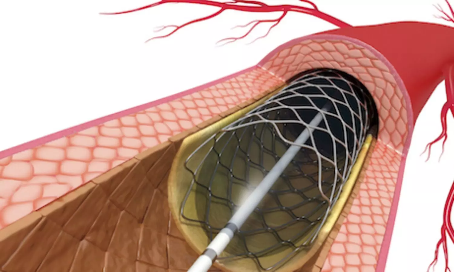 Lower mortality rates seen with pharmaco-invasive strategy than late primary PCI in STEMI patients