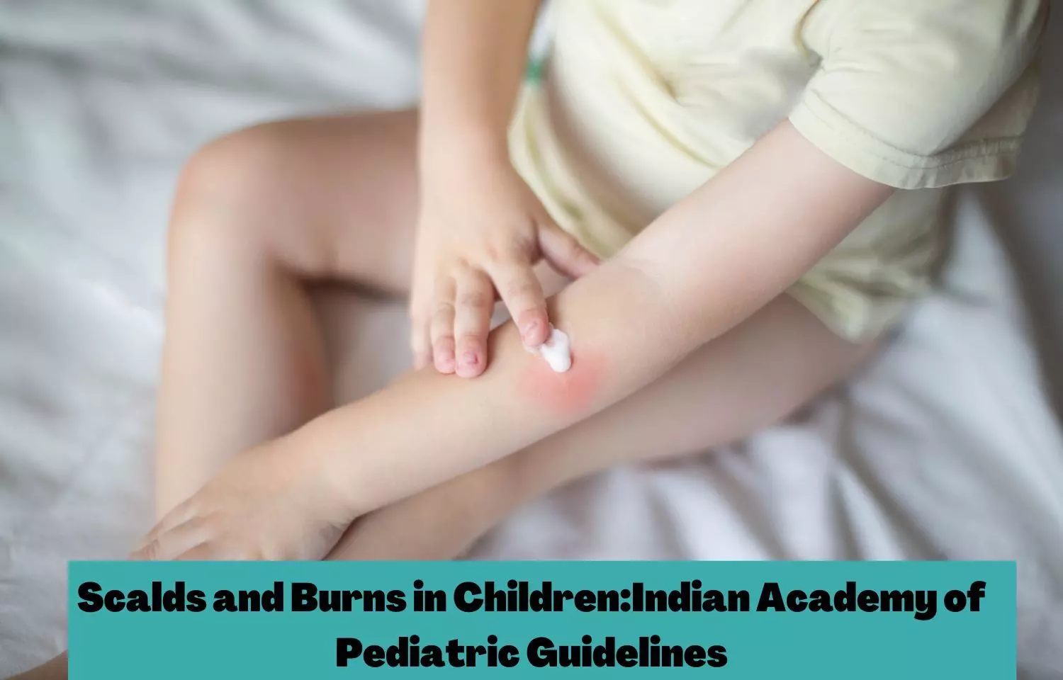 Scalds and Burns in Children: Indian Academy of Pediatric Guidelines