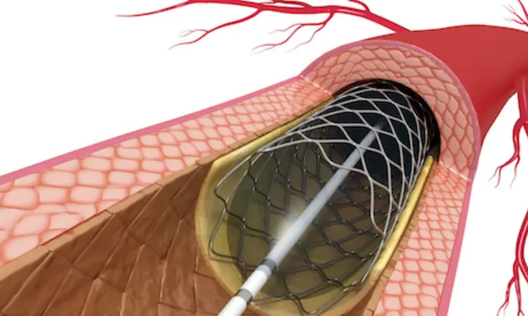 PCI with everolimus-eluting stents reported more MACE, finds a study: NEJM