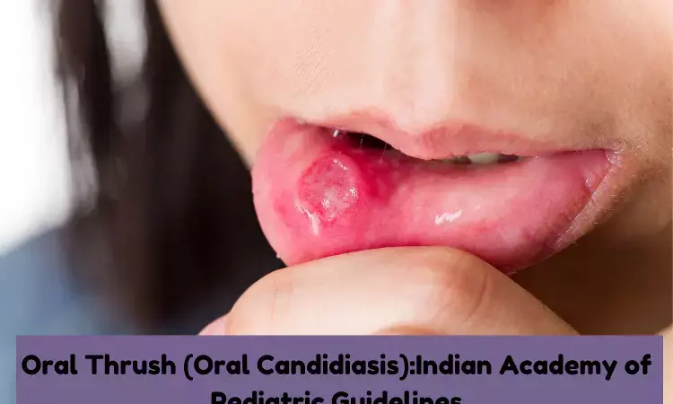 Oral Thrush:Indian Academy of Pediatric Guidelines