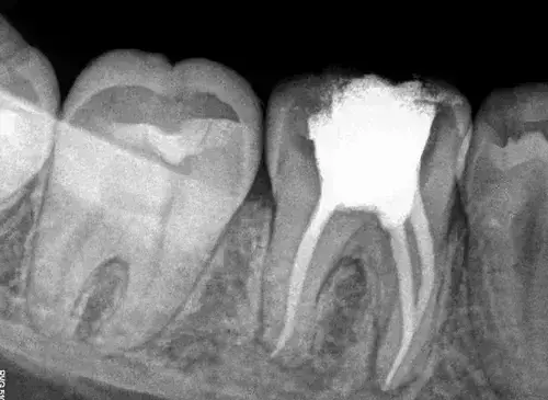 What are key Predictors of Early Endodontic Treatment Failure after imary root canal treatment?