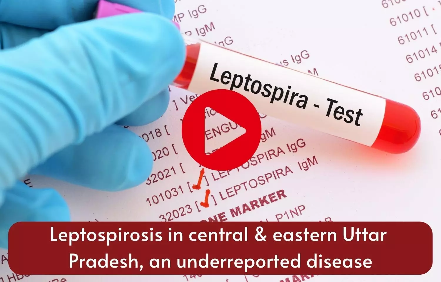 Leptospirosis in central & eastern Uttar Pradesh, an underreported disease