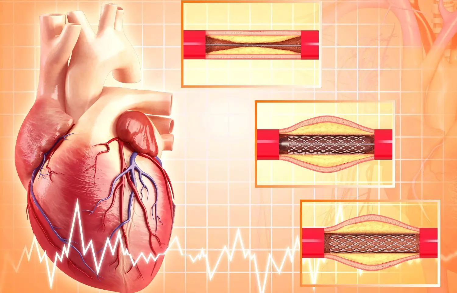 Coronary stenting may not benefit patients of CAD with severe left ventricular dysfunction