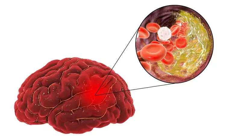 Milvexian shows potential to reduce risk of ischaemic stroke