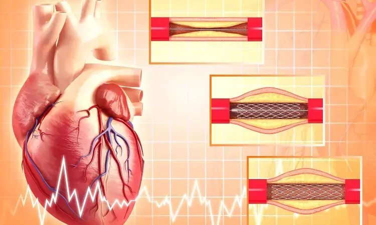 Complete revascularization in STEMI results in improved angina relief: JAMA