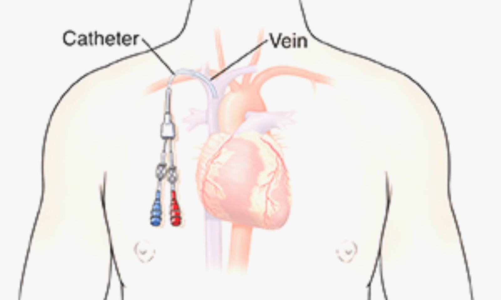 central venous catheter