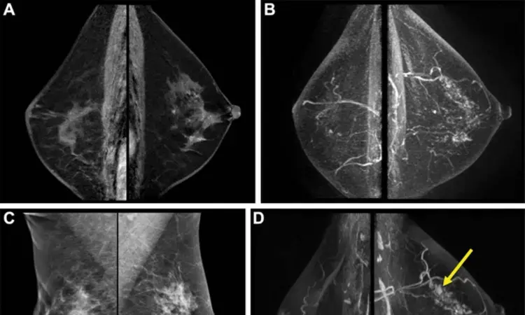 Breast tissue features on MRI may illuminate risk of second breast cancer