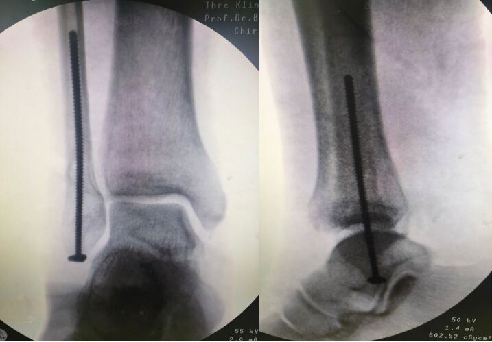 Percutaneous Intramedullary Screw Solid Alternative To Neutralization