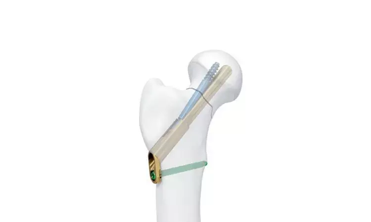 FNS implant a minimally invasive alternative to DHS in treatment of femur neck fractures