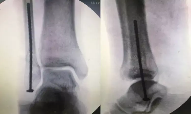 Percutaneous intramedullary screw solid alternative to neutralization plate for Lateral malleolar fractures