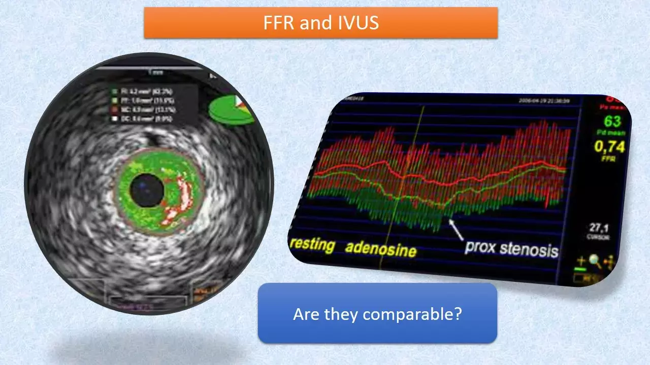 FFR is non-inferior to IVUS in improving PCI outcomes, FLAVOUR study.