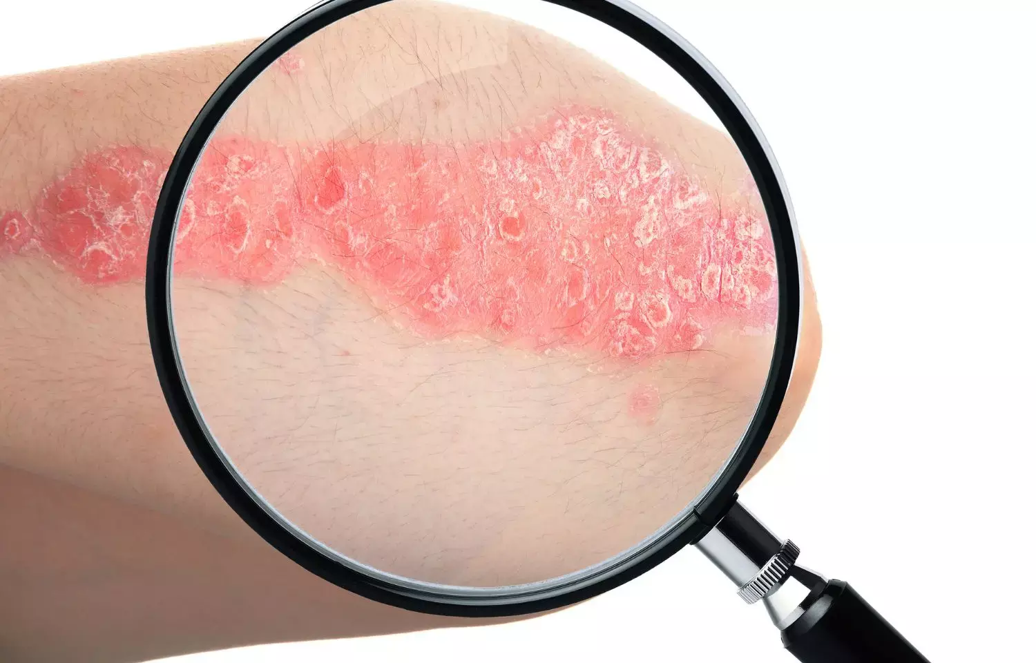 FDA approves spesolimab for treatment of generalized pustular psoriasis flares in adults