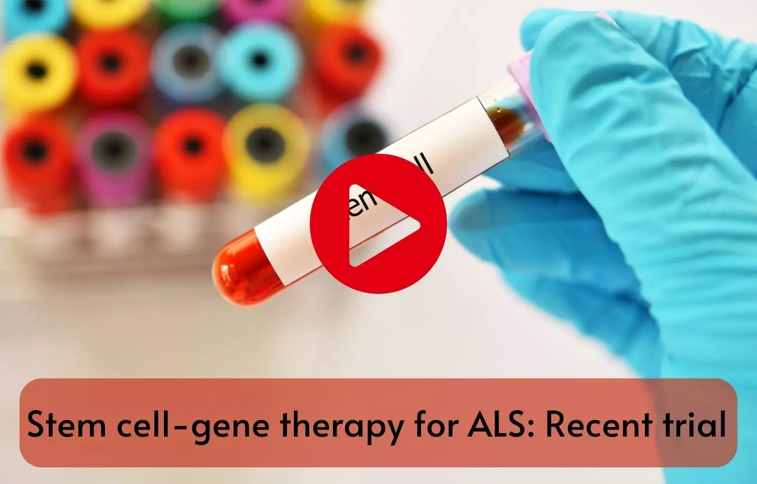 Stem cell-gene therapy for ALS: Recent trial