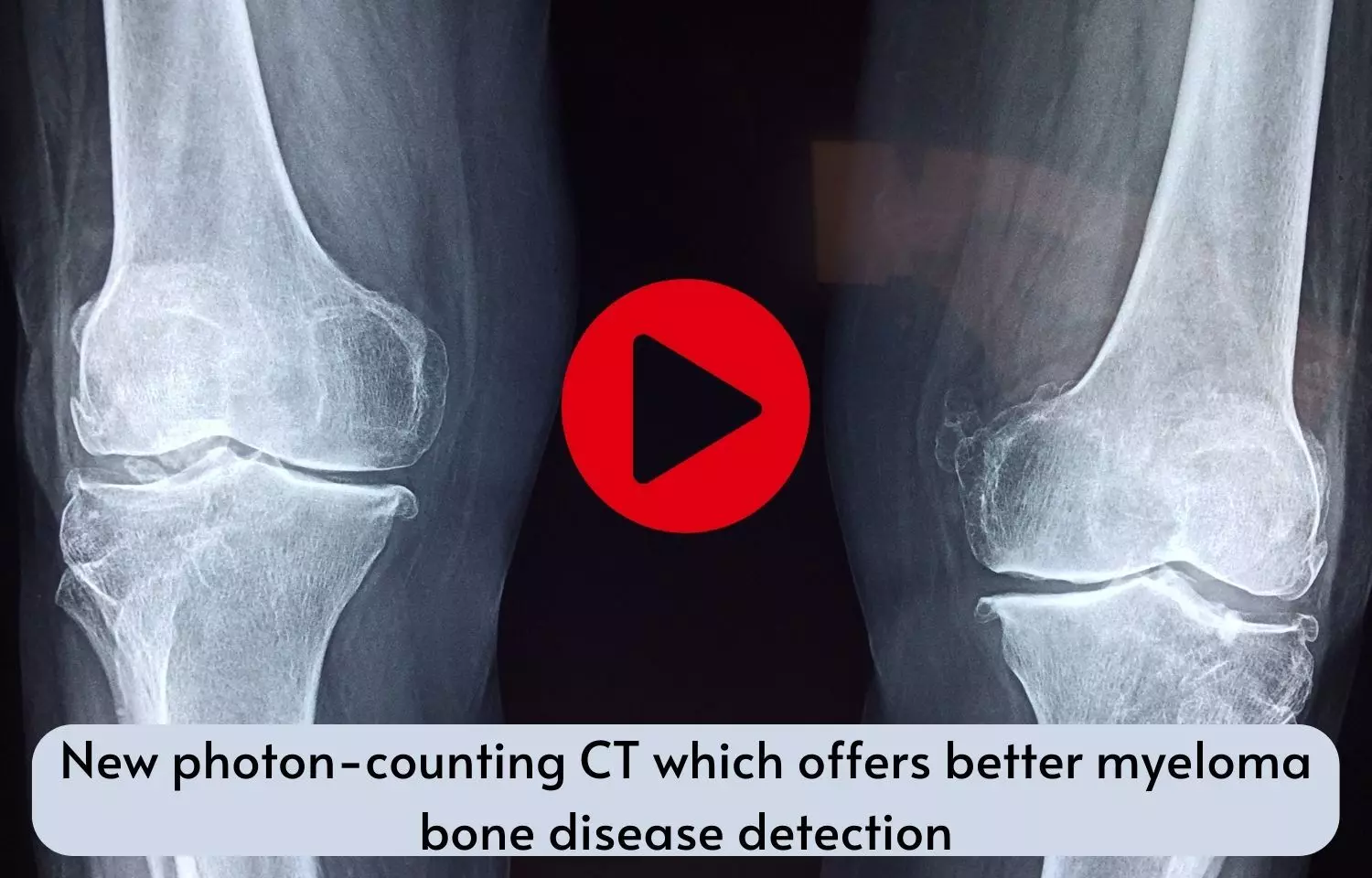 New photon-counting CT which offers better myeloma bone disease detection