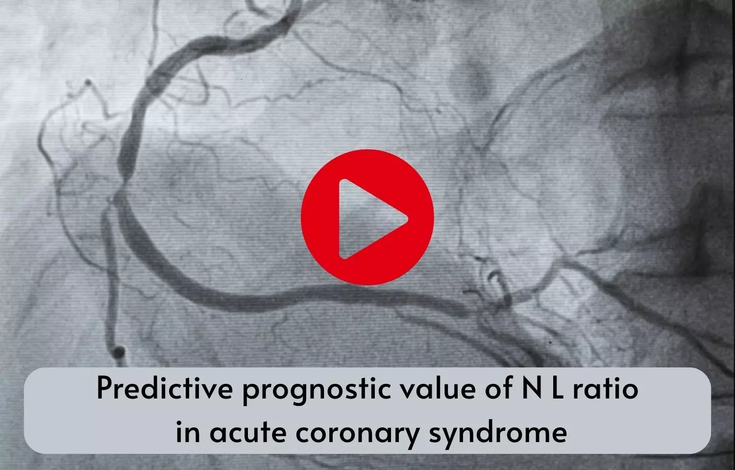 Predictive prognostic value of N L ratio in acute coronary syndrome