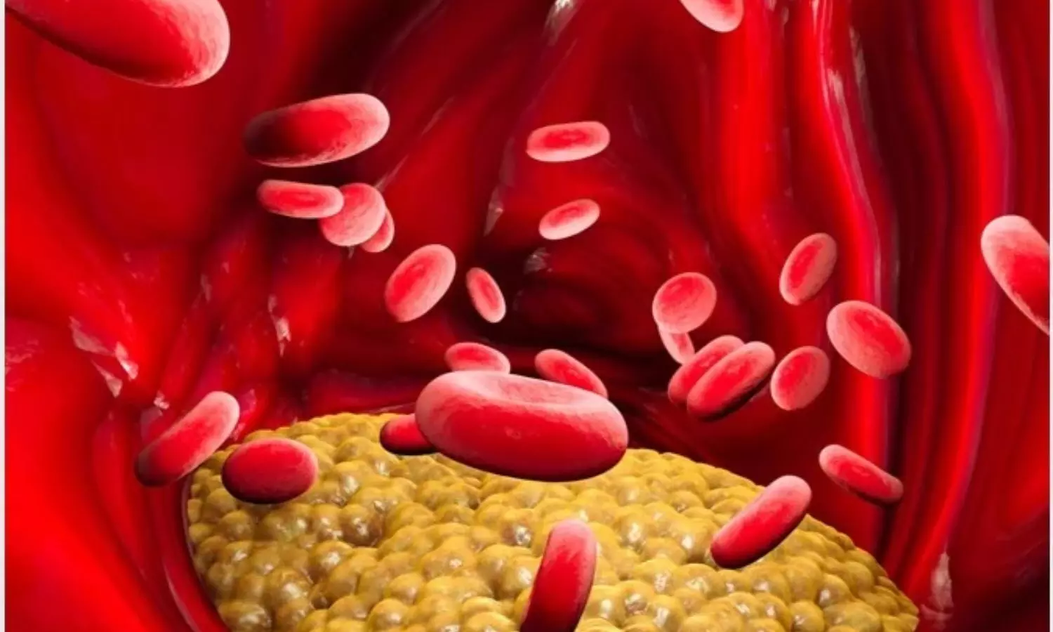 Earlier onset of hypertriglyceridemia increases   risk of CVD and mortality: JAHA