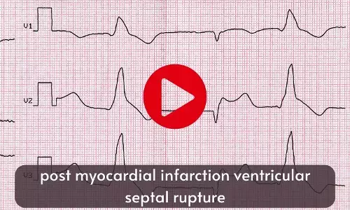 Percutaneous closure of post myocardial infarction ventricular septal rupture