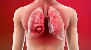 Nalbuphine beneficial for idiopathic pulmonary fibrosis related Chronic Cough in Early Trial