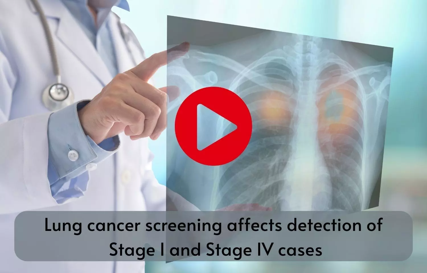Lung cancer screening affects detection of Stage I and Stage IV cases