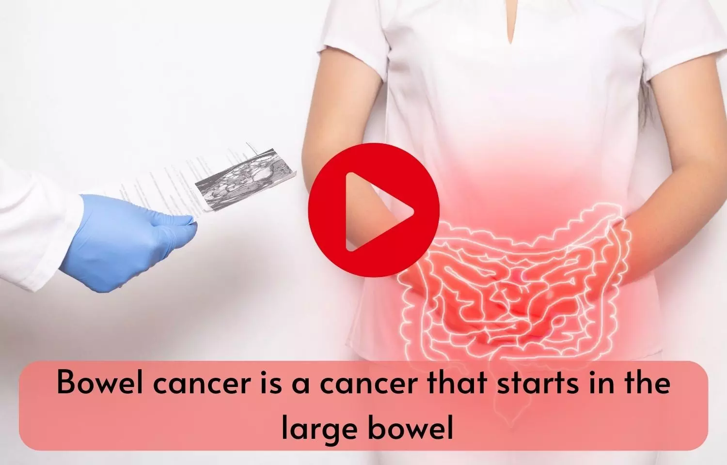 Bowel cancer is a cancer that starts in the large bowel