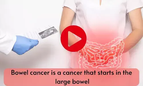 Bowel cancer is a cancer that starts in the large bowel