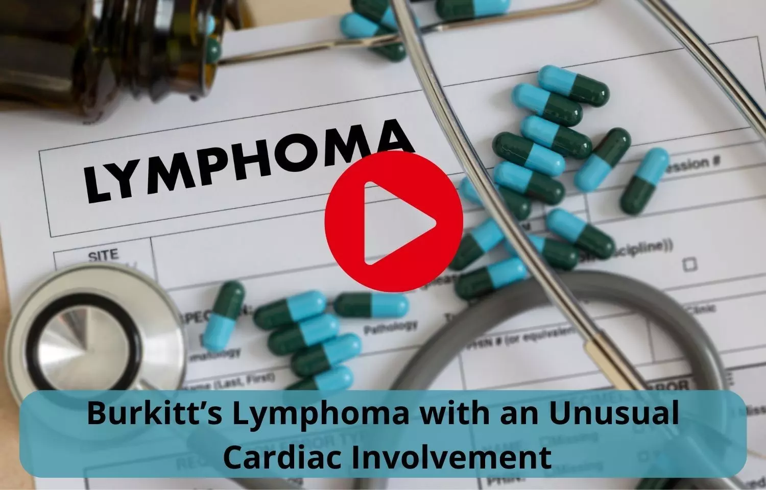 Burkitts Lymphoma with an Unusual Cardiac Involvement