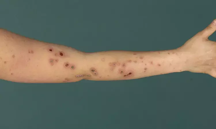 Dupilumab significantly improves skin lesions and itching among treated patients with prurigo nodularis