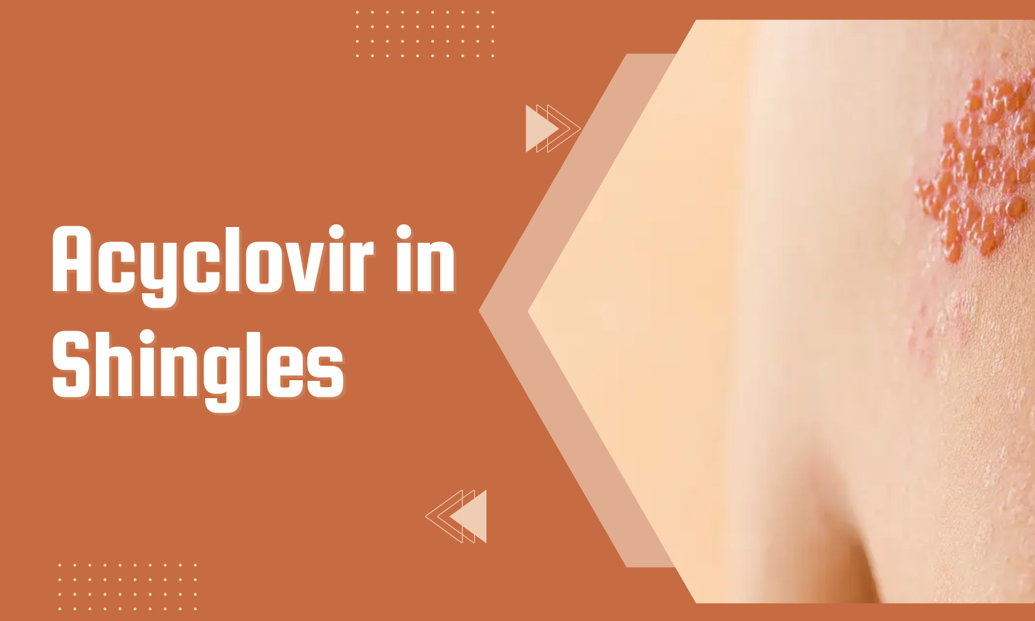 acyclovir-a-review-of-its-use-in-the-management-of-shingles