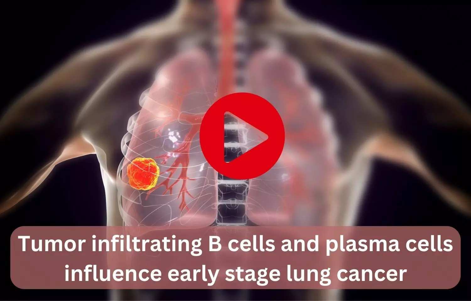 Tumor-infiltrating B cells and plasma cells influence early-stage lung  cancer