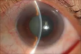 Cataract patients with uveitis may develop uveitis flare and cystoid macular oedema after surgery
