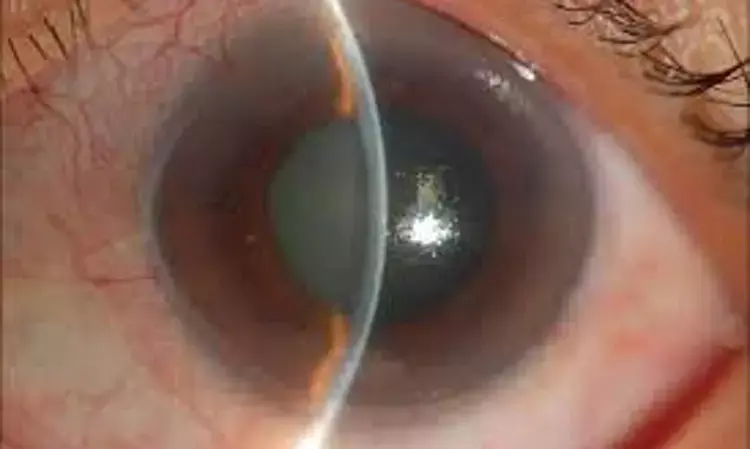 Cataract patients with uveitis may develop uveitis flare and cystoid macular oedema after surgery