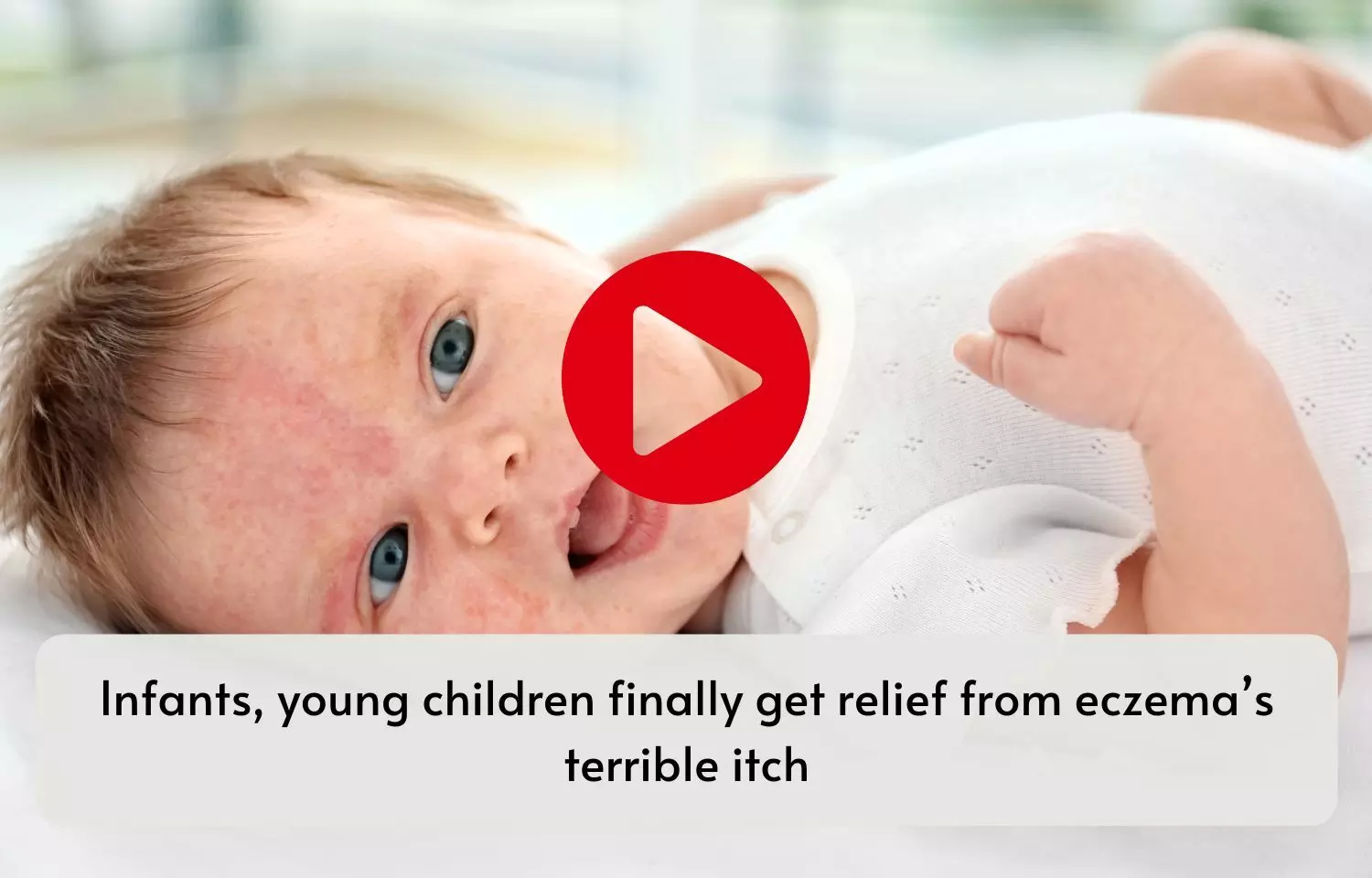 Infants, young children finally get relief from eczemas terrible itch