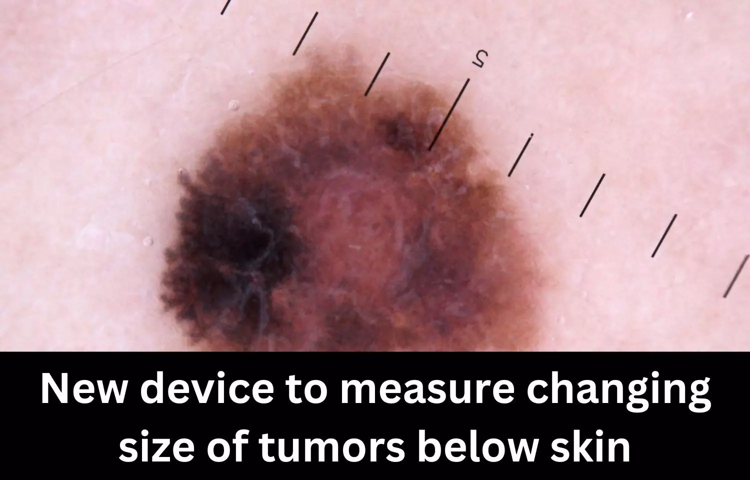 New device discovered by scientists to measure changing size of tumors below skin