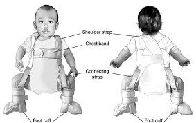 Pavlik Harness treatment may help  accelerate development of acetabulum in patients less than 6 months old