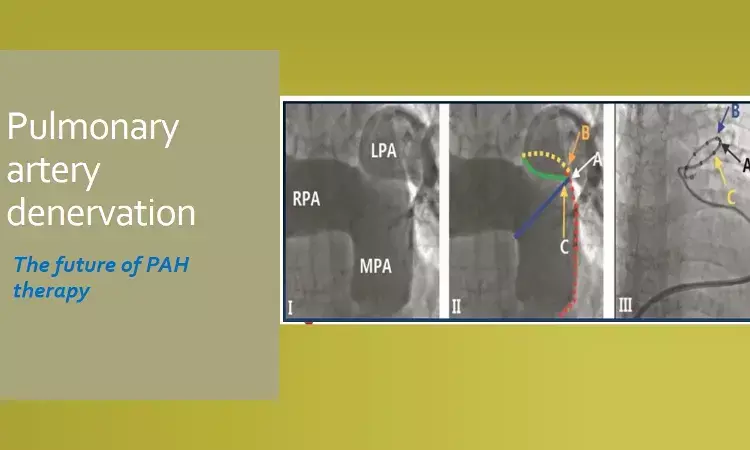 Pulmonary artery denervation shows promise for group I PAH patients, JACC study.