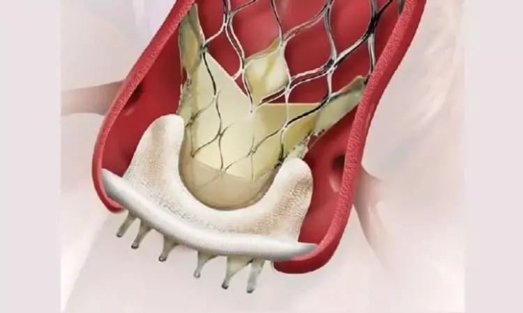 Valve-in-valve TAVR tied to better short-term survival compared to redo surgery for failed surgical aortic bioprostheses: JAHA
