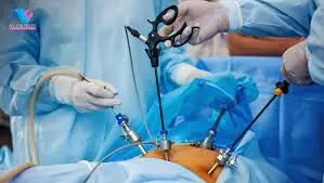 Intraoperative Indocyanine green testing may identify leak during laparoscopic sleeve gastrectomy