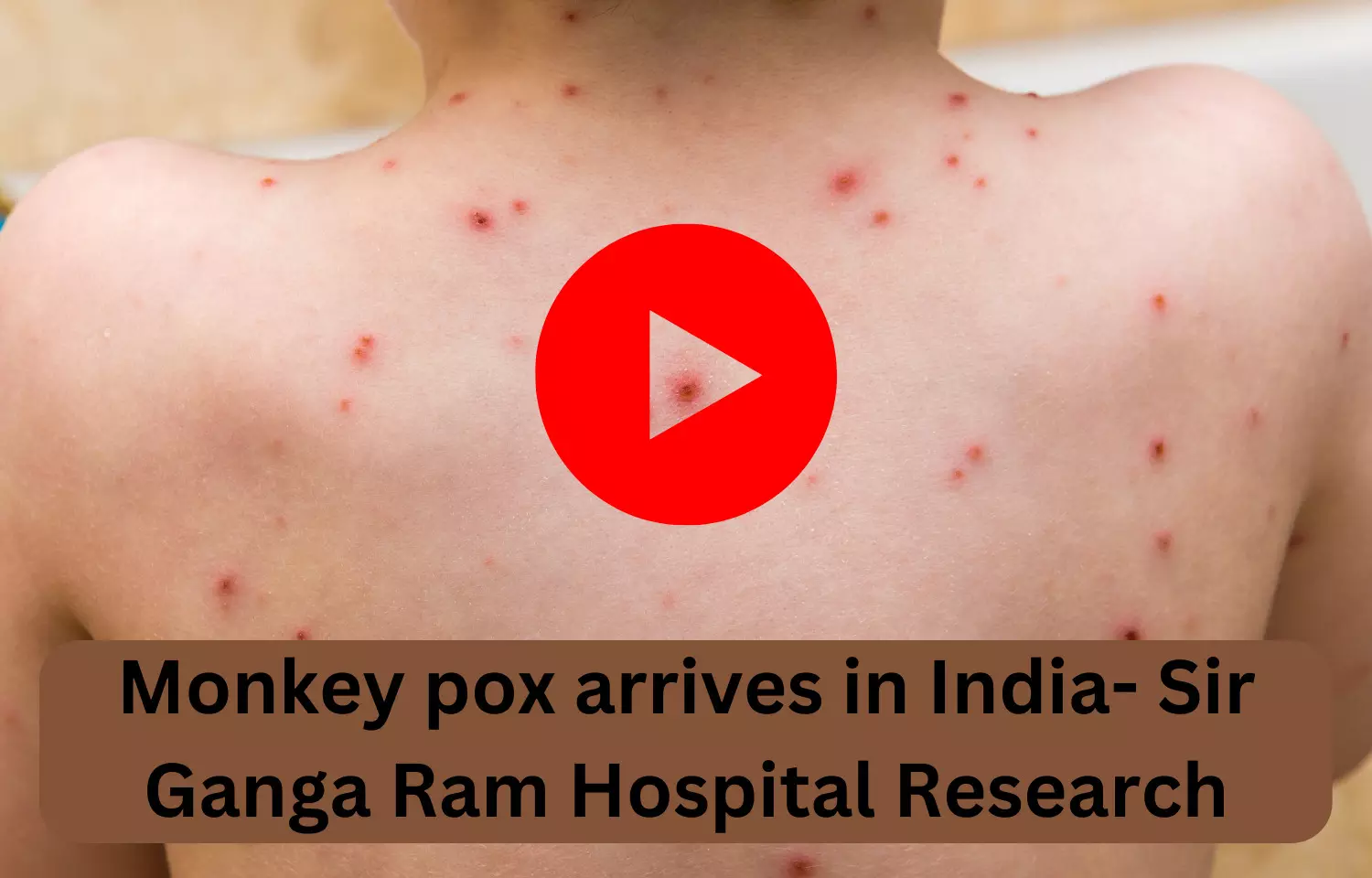 Monkey pox arrives in India-Sir Ganga Ram Hospital Research