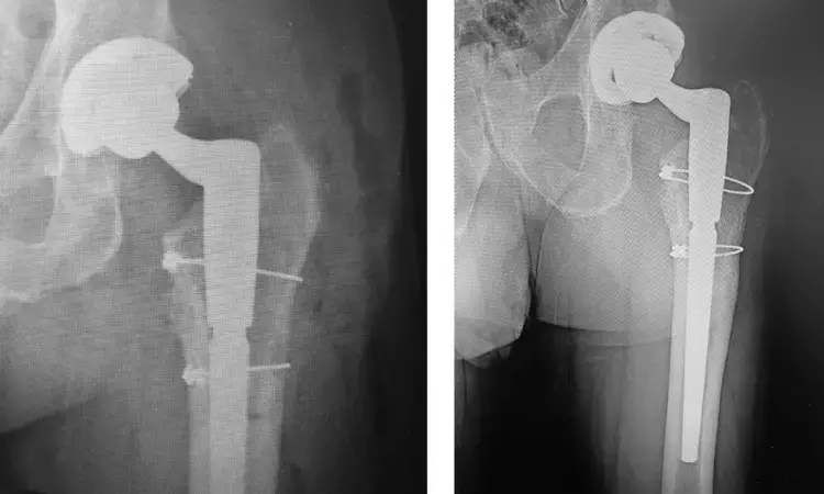 Novel Modification of Extended Trochanteric Osteotomy may save greater trochanter