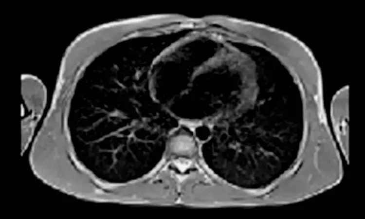 Low-field MRI valuable for monitoring persistent COVID-19 lung damage in children and adolescents: Study