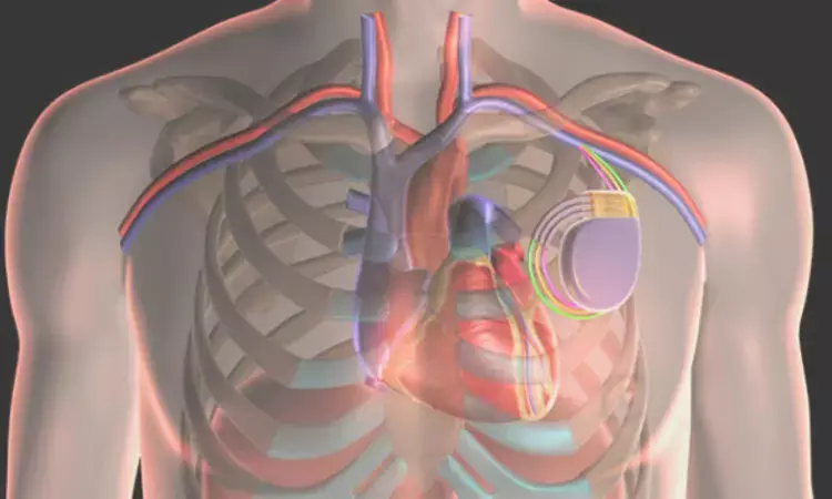 Cardiac resynchronization therapy reduces death, HF hospitalization in patients with IVCD but not RBBB: Circulation