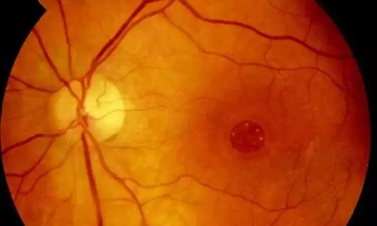 Neutrophillia significantly associated with increased risk of macular edema in type 2 diabetes patients