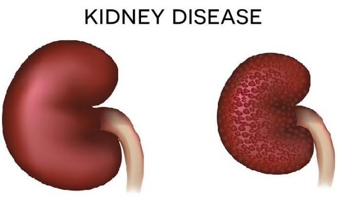 Sparsentan significantly lowered proteinuria compared to Irbesartan in ...