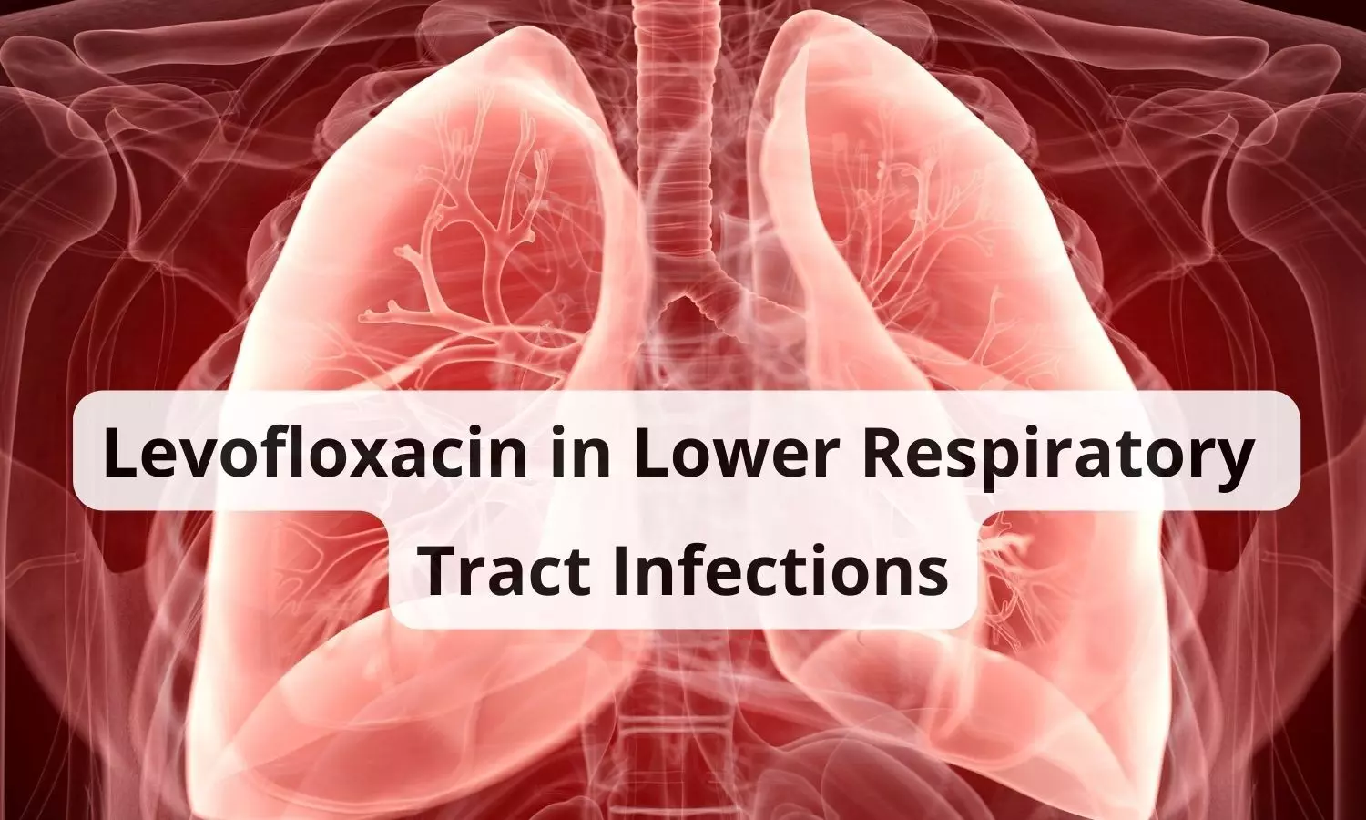 Understanding the Scope of Levofloxacin in Lower Respiratory Tract Infections