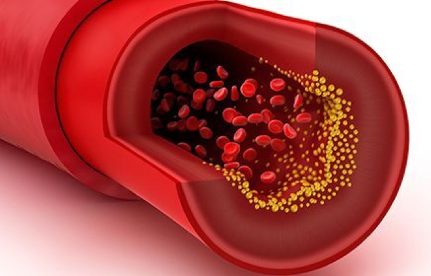 Alogliptin decreases coronary plaque volume in ACS patients with ...